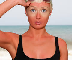 WEIRD SUNBURN REMEDIES